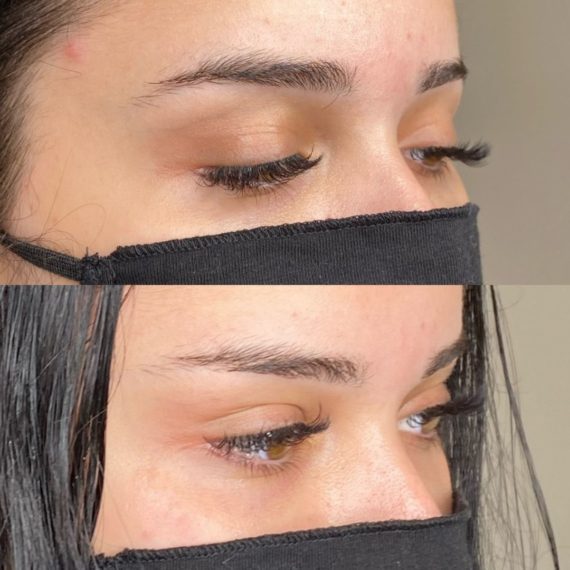 eyebrow lift sas aesthetics before after side mask