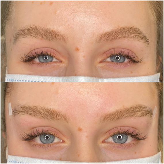 eyebrow lift sas aesthetics before after detail