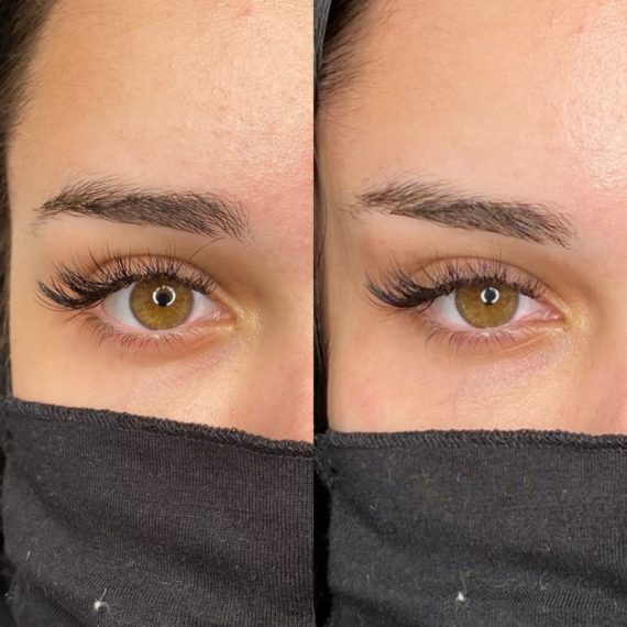 eyebrow lift sas aesthetics before after eye close