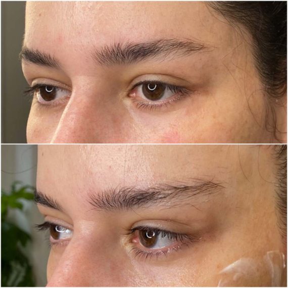 Fox Eyes Thread Lift London before after close up sas aesthetics brows