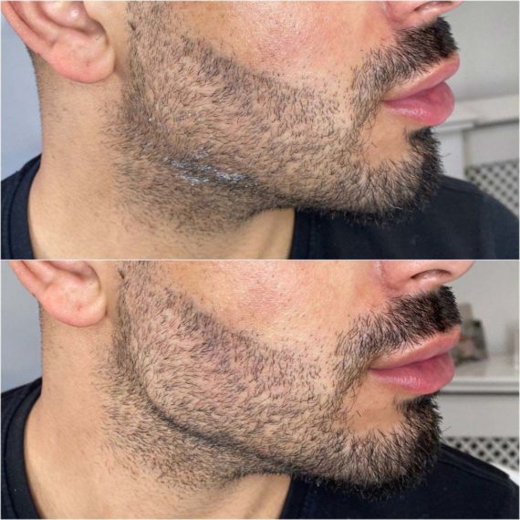 jawline sculpting sas aesthetics male before after