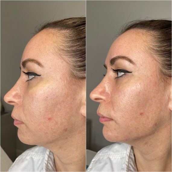 jawline sculpting sas aesthetics female before after side