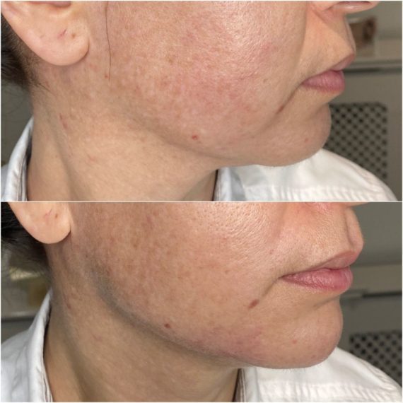 jawline sculpting sas aesthetics female before after