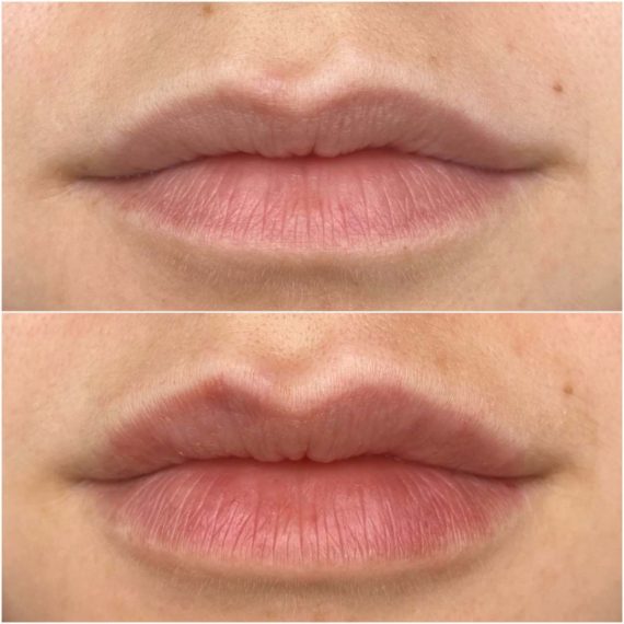 Lip Filler Augmentation in London before after sas aesthetics