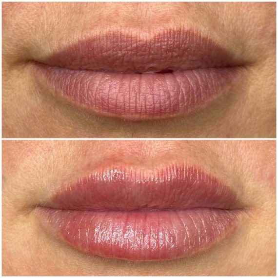 Lip Filler Augmentation in London sas aesthetics before after