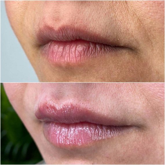 lip filler augmentation before after sas aesthetics