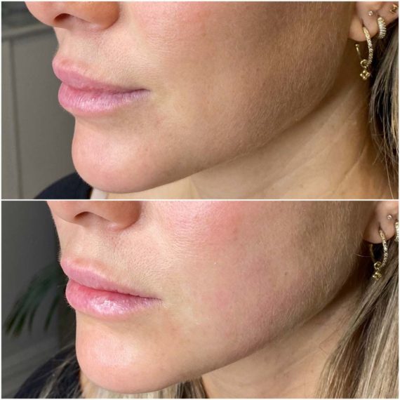 face jaw thread lift before after side sas aesthetics