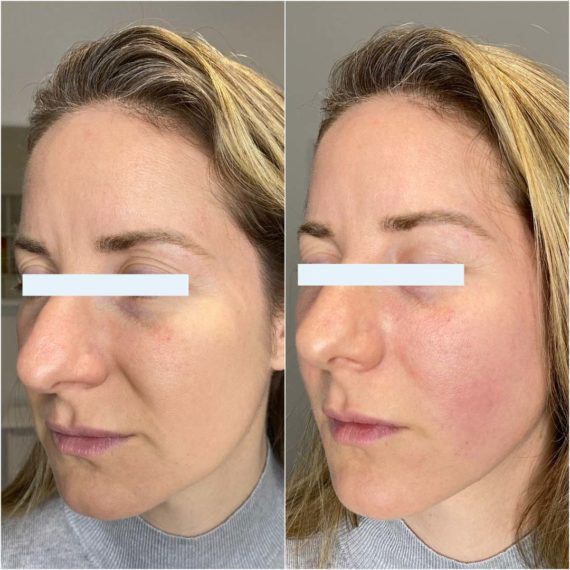 lower face thread lift before after side sas aesthetics