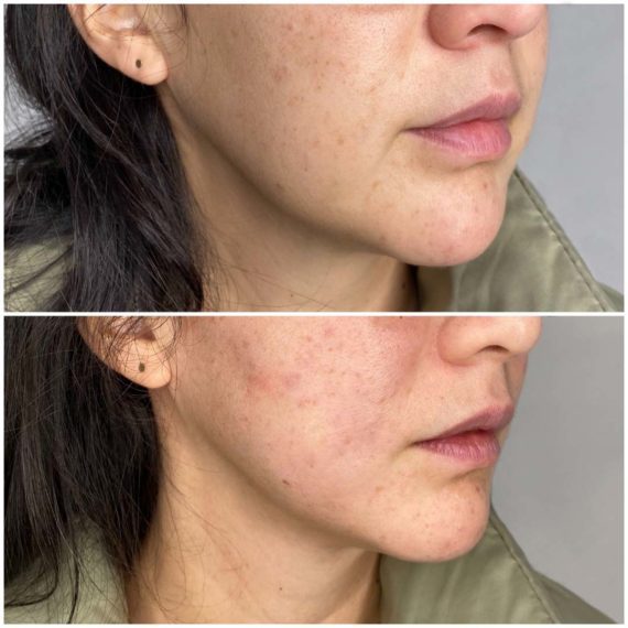 lower face jaw thread lift before after side sas aesthetics