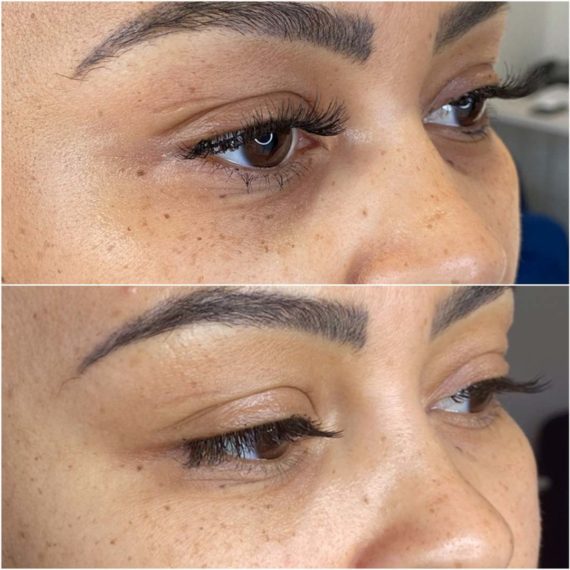 mesotherapy London sas aesthetics before after