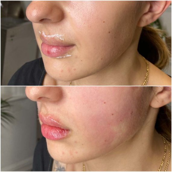 mid face lift lips before after sas aesthetics