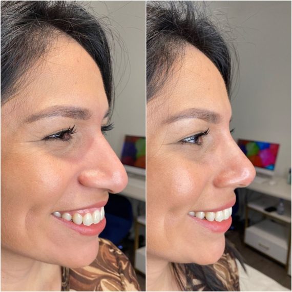 Nose Thread Lift Harley Street sas aesthetics before after