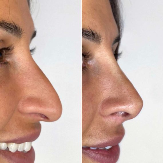 nose thread lift sas aesthetics before after detail side