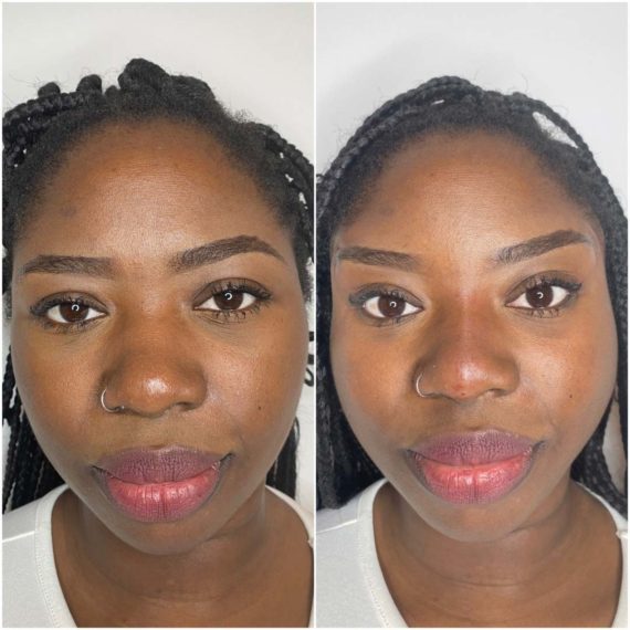 nose thread lift sas aesthetics before after front
