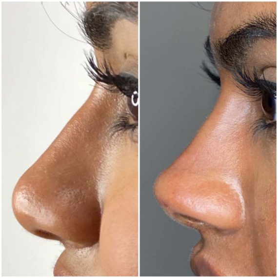 nose thread lift sas aesthetics before after detail side