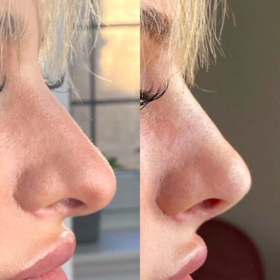 nose thread lift sas aesthetics before after detail