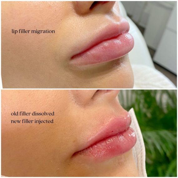 lip filler migration sas aesthetics female before after fat dissolving