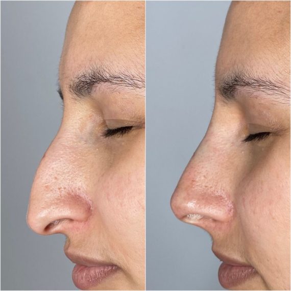 nose thread lift sas aesthetics before after