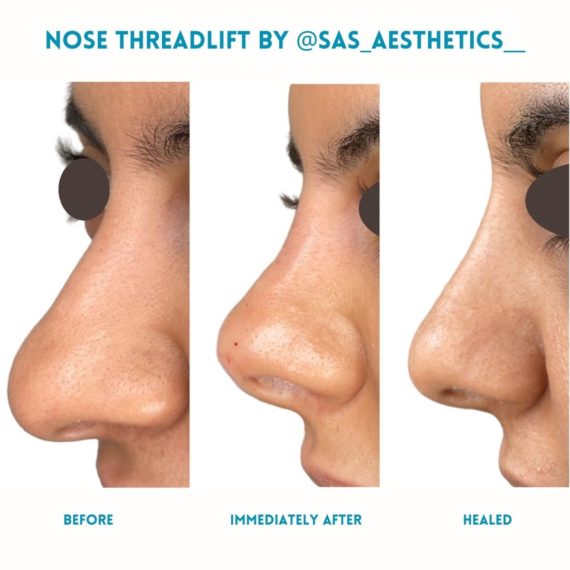 Nose Thread Lift SAS Aesthetics before after healed