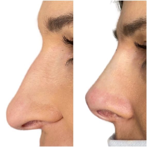 SAS Nose Thread Lift before after sas aesthetic