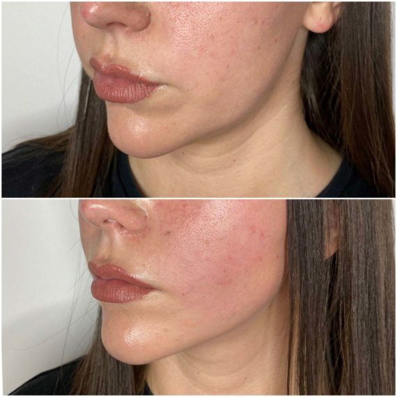 lower face thread lift before after sas aesthetics