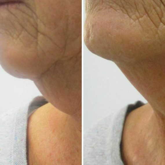 chin sofwave treatment before after lower face sas aesthetics