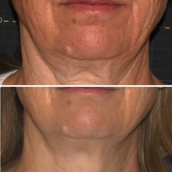 sofwave treatment before after lower face sas aesthetics