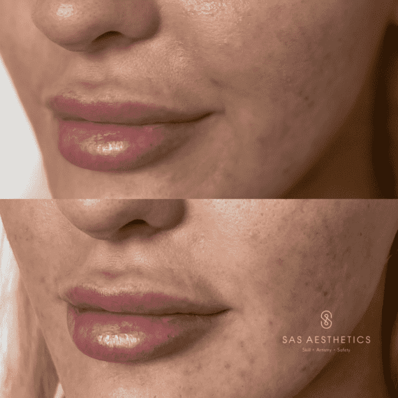 Skin Rejuvination lower face software sas aesthetics treatment