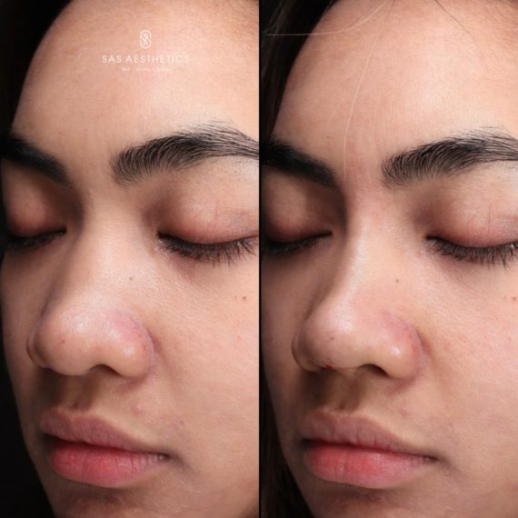 non surgical rhinoplasty non surgical before after SAS aesthetics