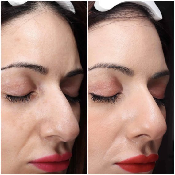 non surgical rhinoplasty Full Face Rejuvination Full Face Rejuvination 3-min before after sas aesthetics