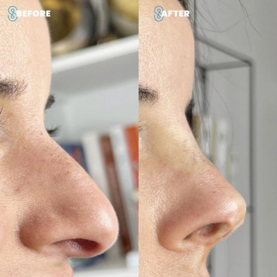 non surgical rhinoplasty before after nose thread sas aesthetics