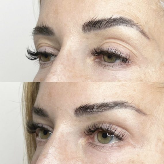 close up threadlifts eyes woman before after nose sas aesthetics