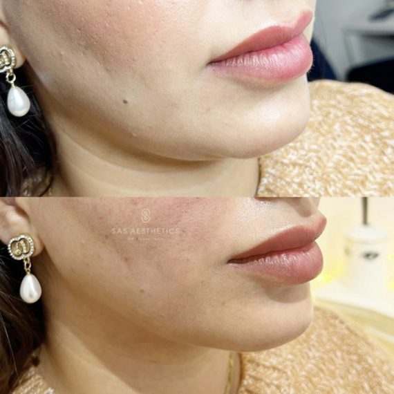 threadlifts 6-min non surgical before after sas aesthetics