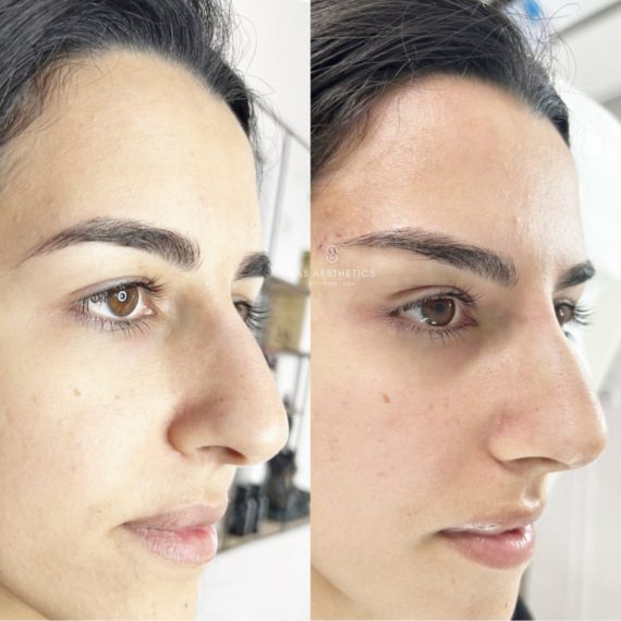 close up thread lift sas aesthetics before after