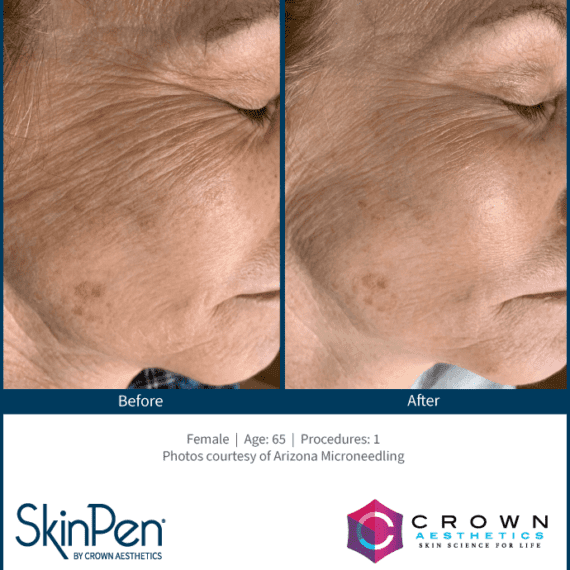 Skinpen - Before and After 2-min