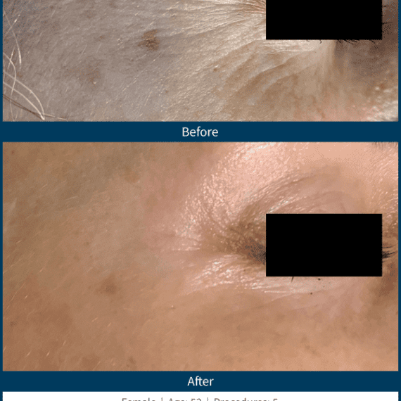 Skinpen - Before and After 4-min