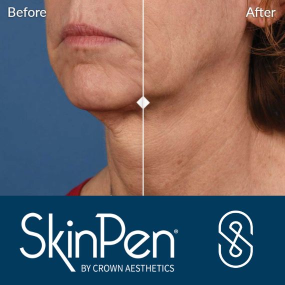 skin pen before after skin wrinkles woman