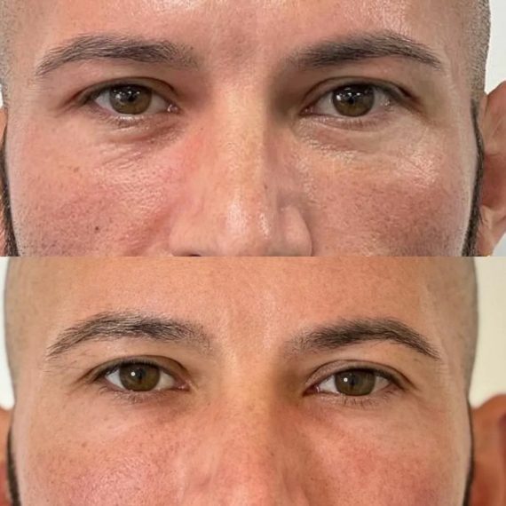 man brows eyes before after Polynucleotide Injection treatment