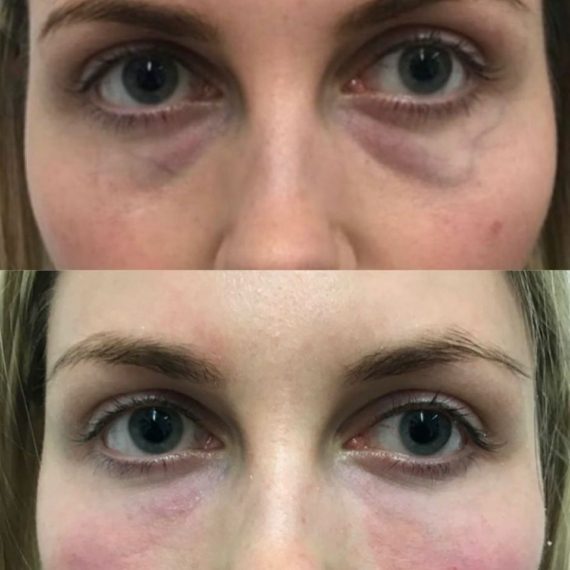 woman face before after Polynucleotide Injection treatment