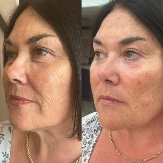 woman face side profile before after Polynucleotide Injection treatment