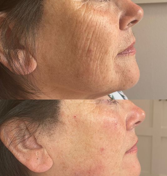 woman lower side face before after Polynucleotide Injection treatment