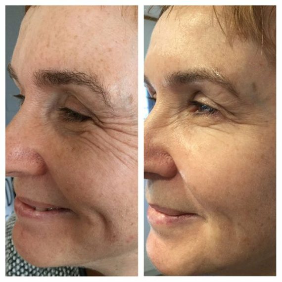 woman smiling side face before after Polynucleotide Injection treatment